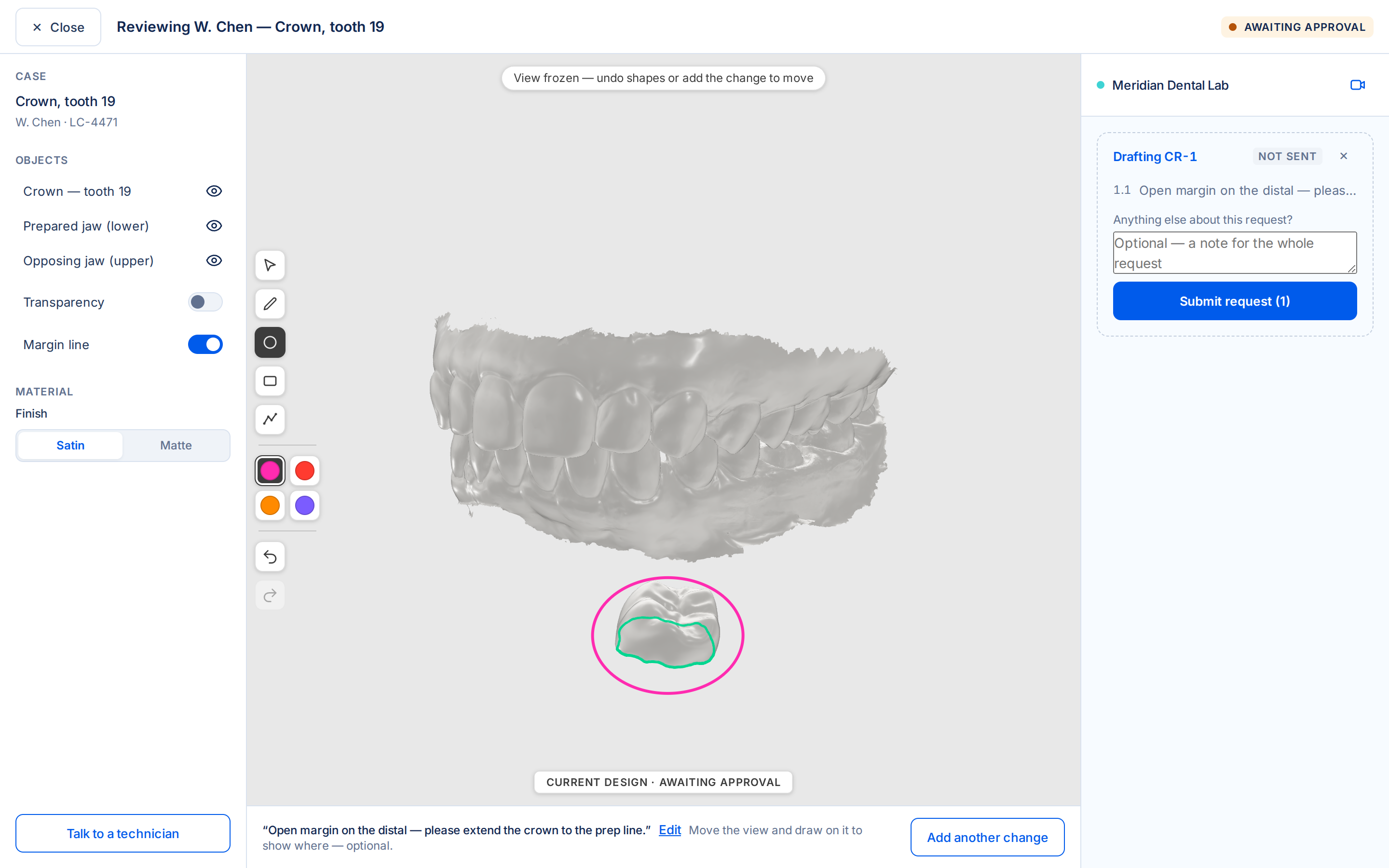 The Lecron design preview: a dentist reviewing a 3D crown design with an annotation marked on the margin.